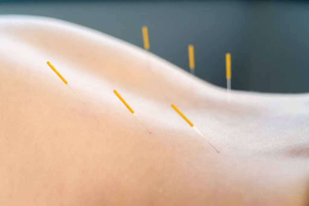 Dry Needling in Physio Solutions